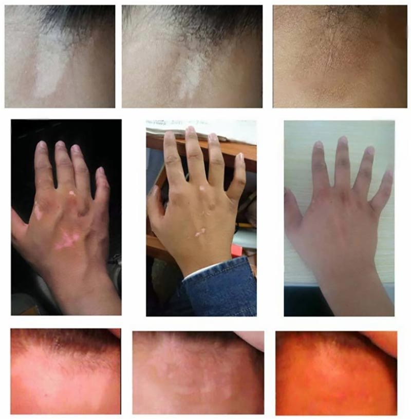 Ultraviolet Phototherapy Device