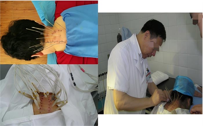 Silver Needle Thermal Conduction Therapy Instrument