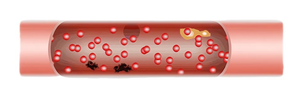 Magnetic Vibration Heat Treatment Instrument