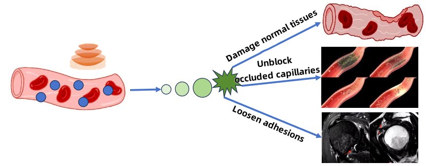 Single Channel Shock Wave Therapy System