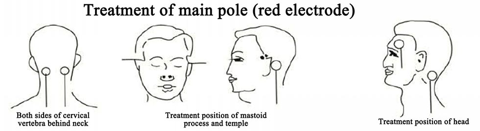 Electroencephalographic Bionic Stimulator