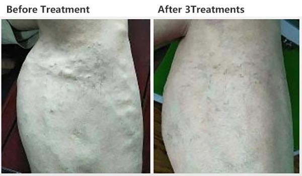 Semiconductor Laser Therapeutic Apparatus