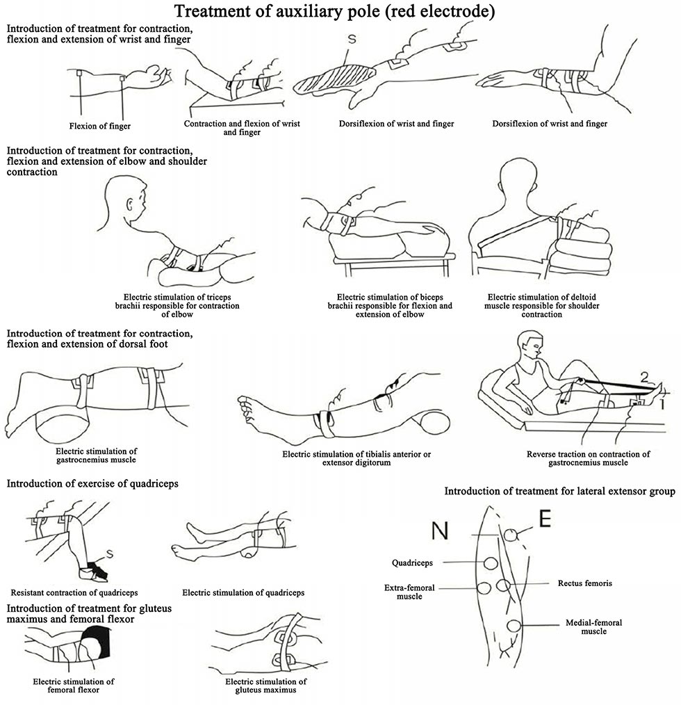 Electroencephalographic Bionic Stimulator