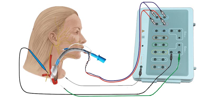 Electromyogram Tracheal Tube